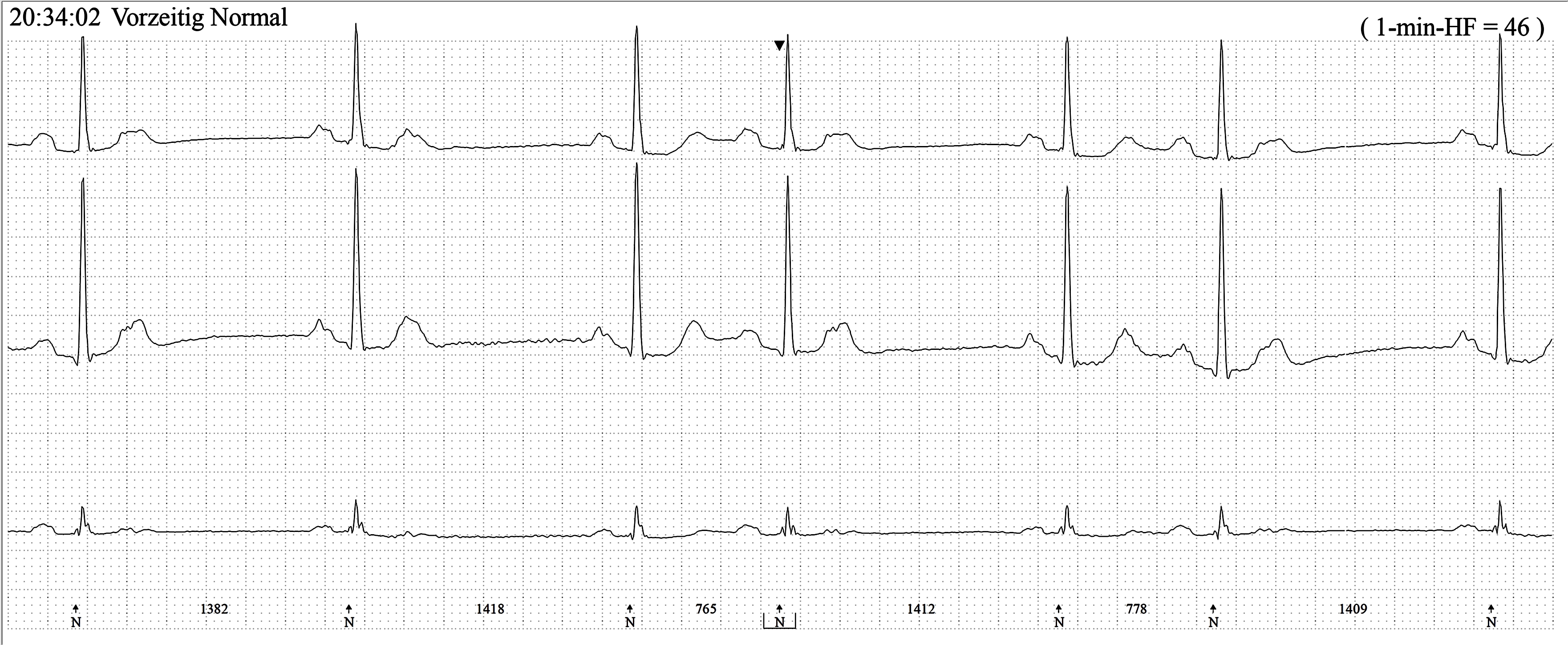 non-conducted-pacs-ecg-guru-instructor-resources